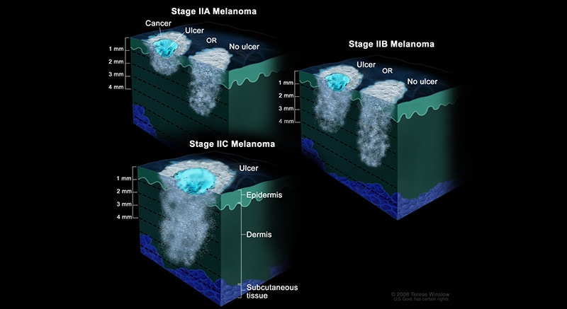 The 5 Stages of Nail Melanoma 12