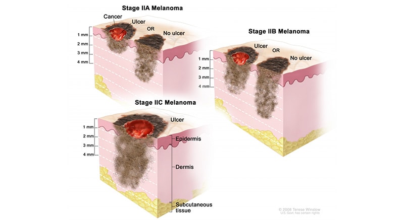 The 5 Stages of Nail Melanoma 11