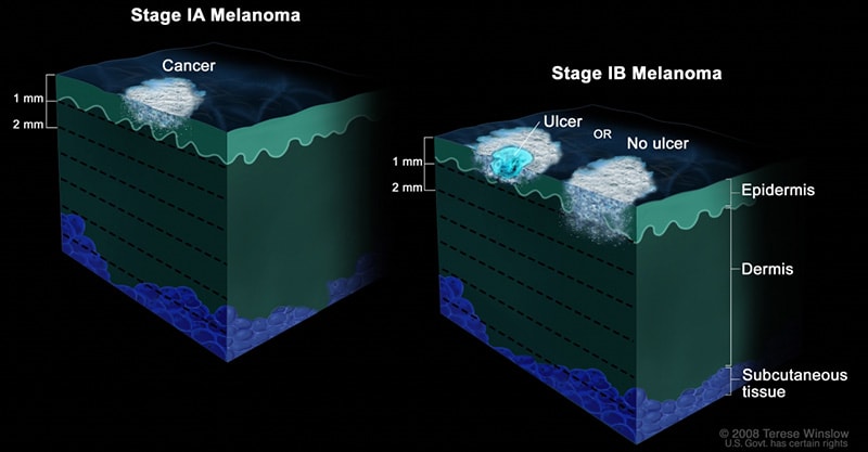 The 5 Stages of Nail Melanoma 10