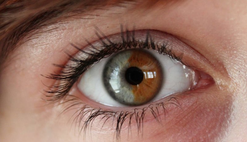 Central Heterochromia – Reasons, Possibility and its Types 37