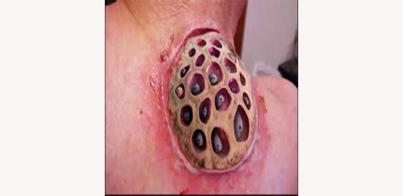 Trypophobia and its Causes –How Do You Get Trypophobia? 6