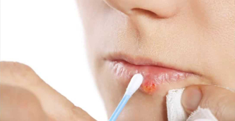 Easy Tips to Get Rid of Awful Cold Sores 27