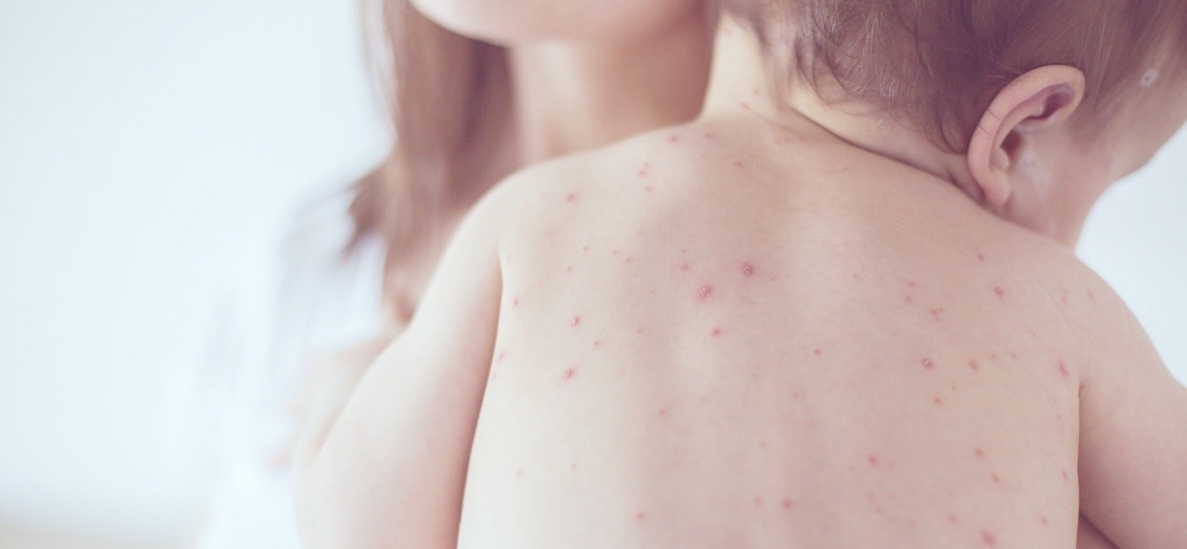 Chickenpox Symptoms in Adults and Teenagers