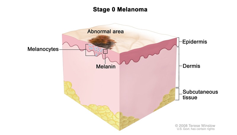 The 5 Stages of Nail Melanoma | upsmash